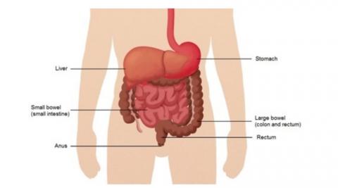 क्या होता है Bowel Cancer