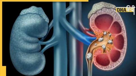 Kidney खराब है तो बढ़ सकता है कैंसर का खतरा