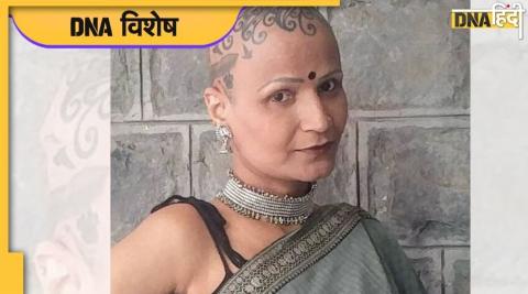 alopecia patient ketki jani