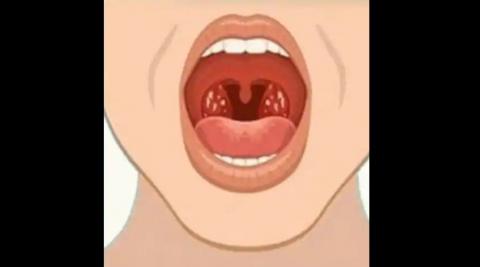 टॉन्सिल (Tonsils)