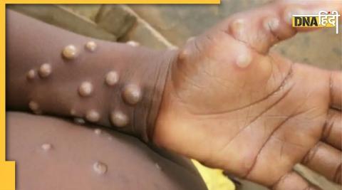 These two drugs are effective in the treatment of monkeypox, this big thing came out in research