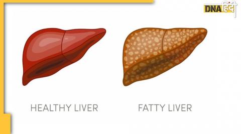 Fatty liver risk due to many reasons including obesity, diabetes