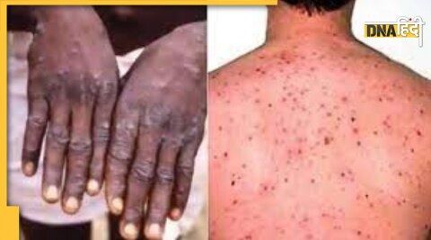 monkeypox cases rising in india