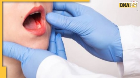 Oral Cancer के लक्षण, इलाज