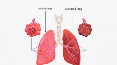 इन गलतियों से फेफड़े होते हैं डैमेज, COPD बीमारी लंग्‍स को बनाती है कमजोर