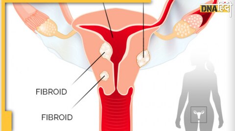 uterine fibroids 