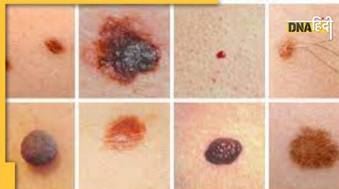 skin cancer symptoms 