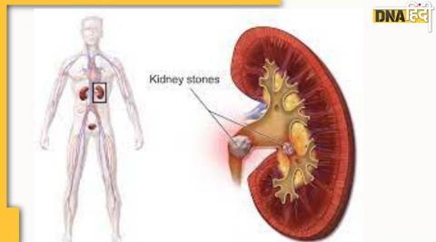 बड़ी से बड़ी पथरी को गलाकर बाहर कर देंगे ये घरेलू नुस्‍खे
