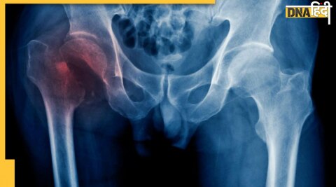 Hip Fracture 