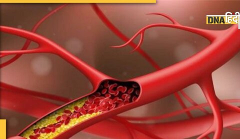 high cholesterol signs arms and leg pain