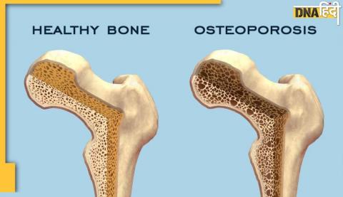 इस बीमारी में खोखली हो जाती हैं हड्डियां, छींकने से भी हो सकता है फ्रैक्चर