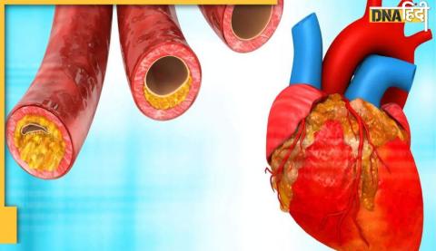 Cholesterol: नहीं पिघल रही नसों में जमी वसा? इस बीज से दूर होगी समस्या