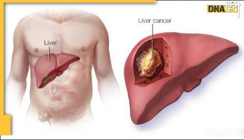 इन कारणों से हो सकता है लिवर कैंसर, ऐसे करें बचाव