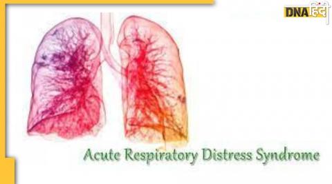 कोरोना के बाद बढ़ रहा एक्‍युट रेस्पिरेटरी डिस्‍ट्रेस सिंड्रोम
