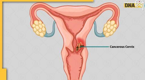 माइक्रो आरएन से होगा सर्वाइकल कैंसर का इलाज, बीएचयू के विज्ञानियों ने खोजी यह थेरेपी