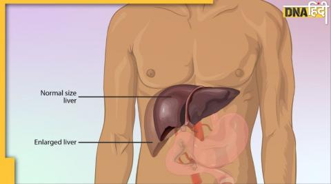 लिवर पर जम गया है फैट? ये 6 चीजें गंदगी समेत पेट की चर्बी भी पिघाला देंगी