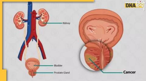 Prostate Cancer Alert: ब्लड में इस प्रोटीन के हाई होने से बढ़ता है पुरुषों में प्रोटेस्ट कैंसर का खतरा