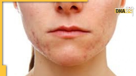 hormonal acne hormone imbalance skin menopause symptoms remedies 