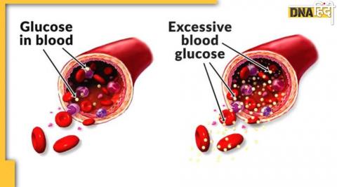 High Blood Sugar Causese: दवा और बैलेंस्ड डाइट से भी कम नहीं हो रहा ब्लड शुगर कंट्रोल? 