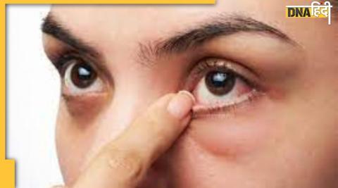 Diabetes Sign In eyes: आंखों में दिखने वाली ये गंभीर बीमारी ब्लड शुगर अनकंट्रोल होने का है संकेत