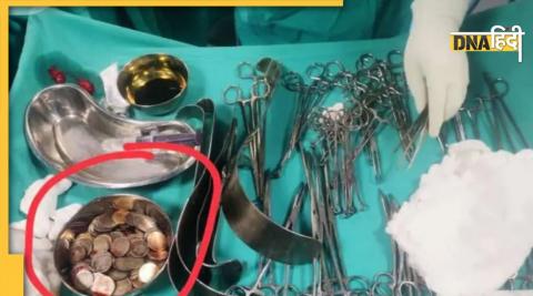 doctors remove coins after surgery 