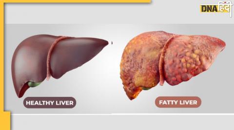 Liver Damage Sign: क्या रोज रात 1 से 4 बजे के बीच टूटती है आपकी नींद? 