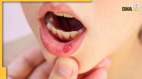 Home Remedy For Mouth Ulcer