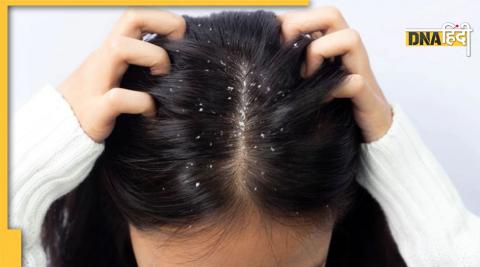 dandruff treatment