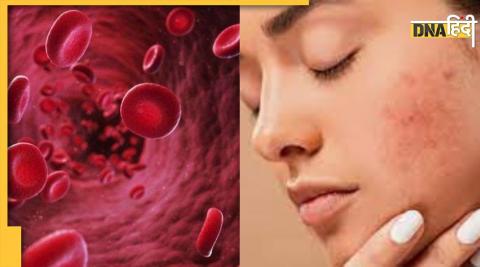 Blood Cancer Symptoms