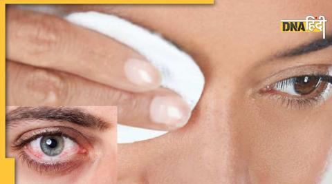 Home Remedies For Red Eyes