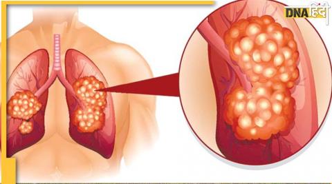 Fatty lungs: फेफड़ों में फैट जमा होने पर दिखते है ये गंभीर लक्षण