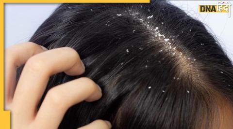 Home remedies to avoid dandruff: डैंड्रफ से बचने के घरेलू नुस्खे