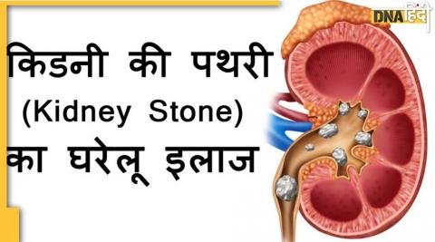 kidney Stone Remedy: खाली पेट पीएं ये खास चीज निकल जाएगा किडनी स्टोन