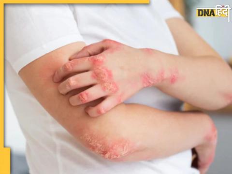 Psoriasis Disease