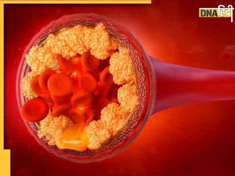 Cholesterol Lowring Tips: ब्लॉक नसें खोल देंगे ये 5 सस्ते उपाय