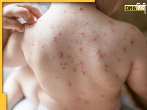 Balia Chickenpox Infection