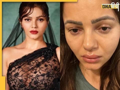 Rubina Dilaik Swollen Lips, Fever, Sore Throat