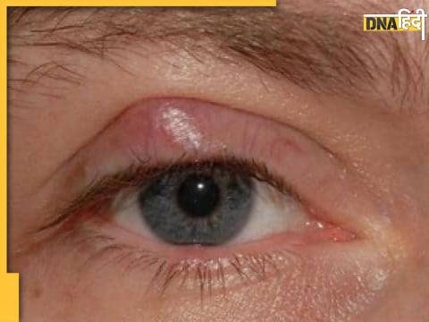 chalazion symptoms and treatment