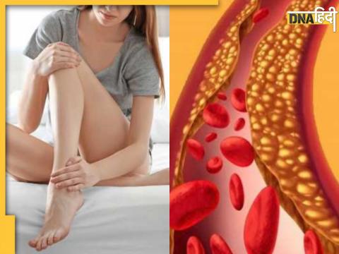 high cholesterol causes symptoms signs