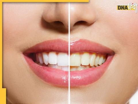 Whiten Yellow Teeth Home Remedy