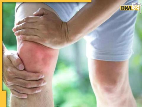 Joints Pain-Uric Acid Causese