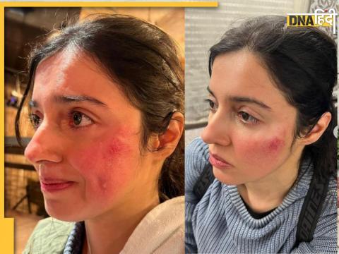 Divya khosla kumar injured while shooting shared images injury scares social media