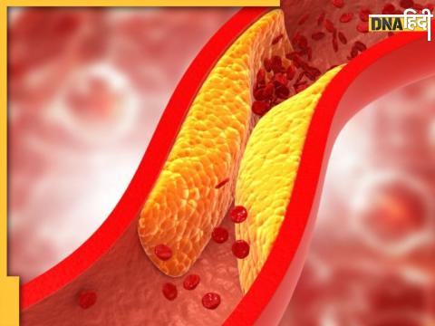 Ayurvedic Herbs To Control High Cholesterol