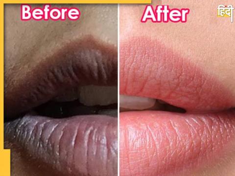 Remedies for dark lips