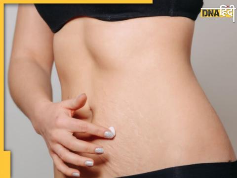 Home Remedies For Stretch Marks