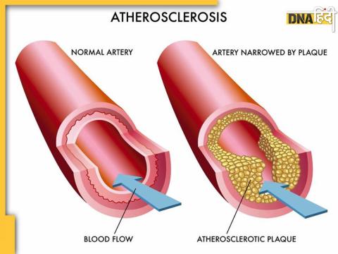 Veins Blockage 