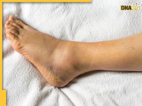 Swelling of feet or ankles