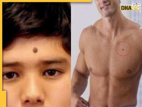 Lucky Moles On Male Body