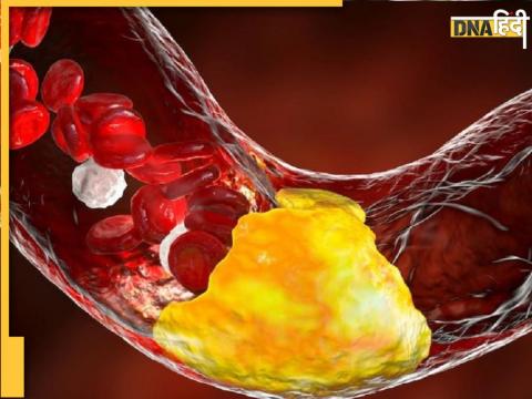 High Cholesterol Due to Dehydration