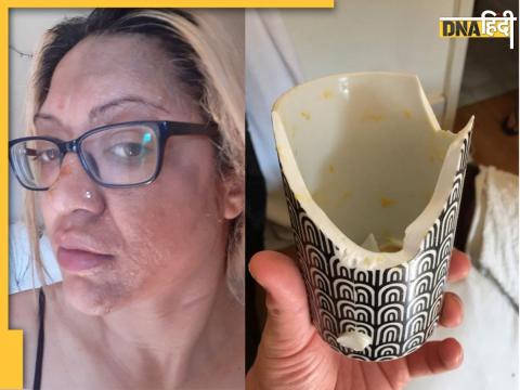 tiktok cooking hack food vlogger woman suffers face burn eggs cooked eggs photos viral